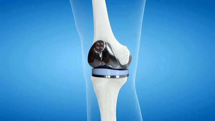 Knee Replacement